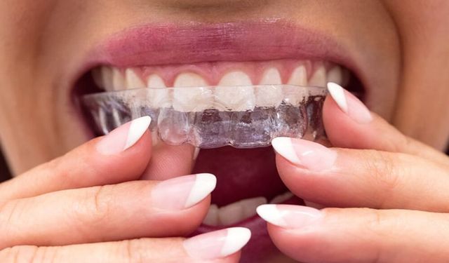 Gülüşlerdeki şeffaf devrim: Şeffaf plaklarla ortodontik tedavi